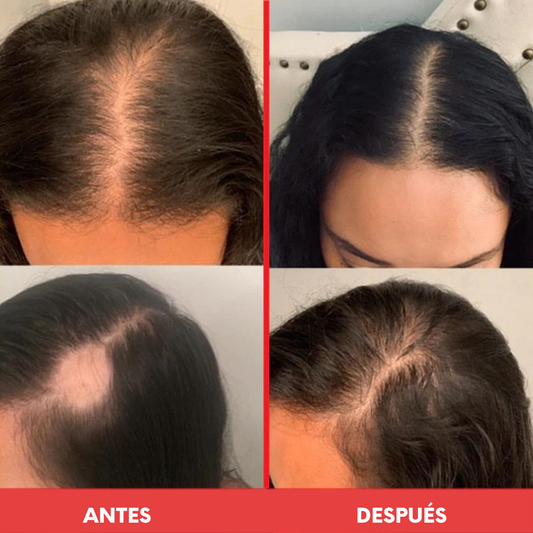 Bundle Crecimiento & Restauración 🔥Fórmula Avanzada X2 + Scalp Serum - HairVitamins.mx
