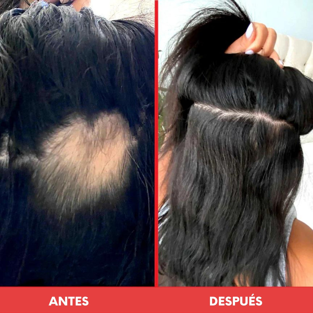 Bundle Yummy 🔥 Gummy Stars X2 + Scalp Serum - HairVitamins.mx